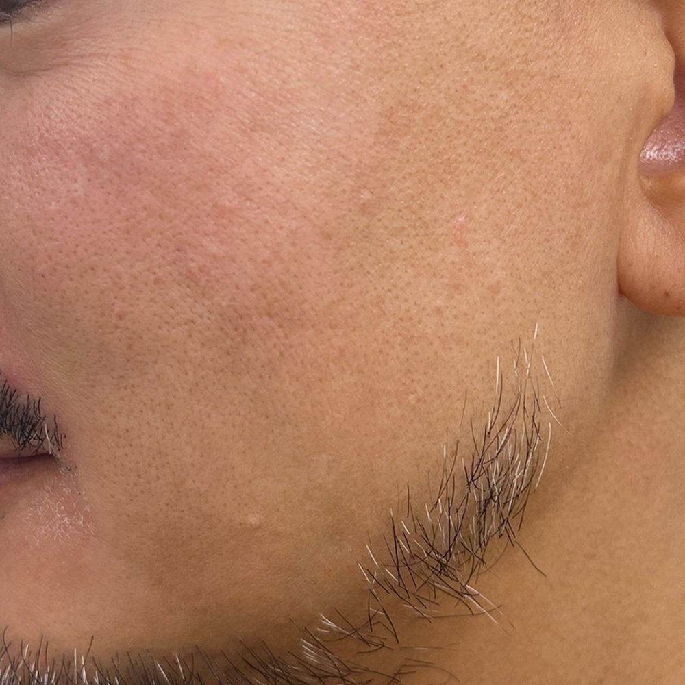 After-Pigmentation