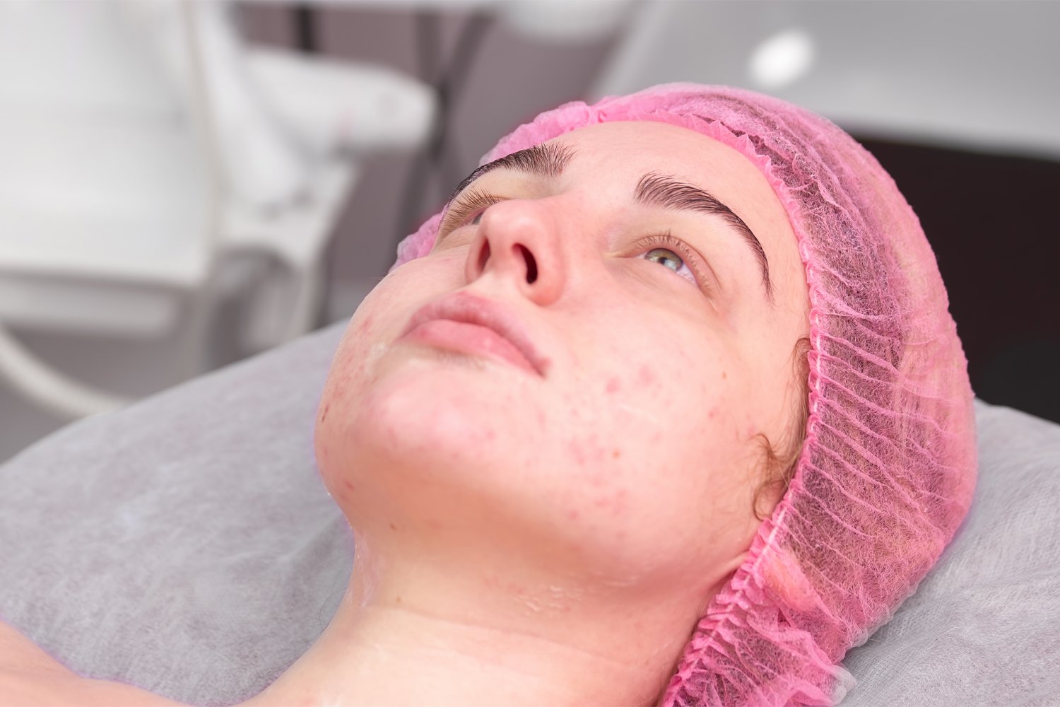ACNE SCAR REMOVAL