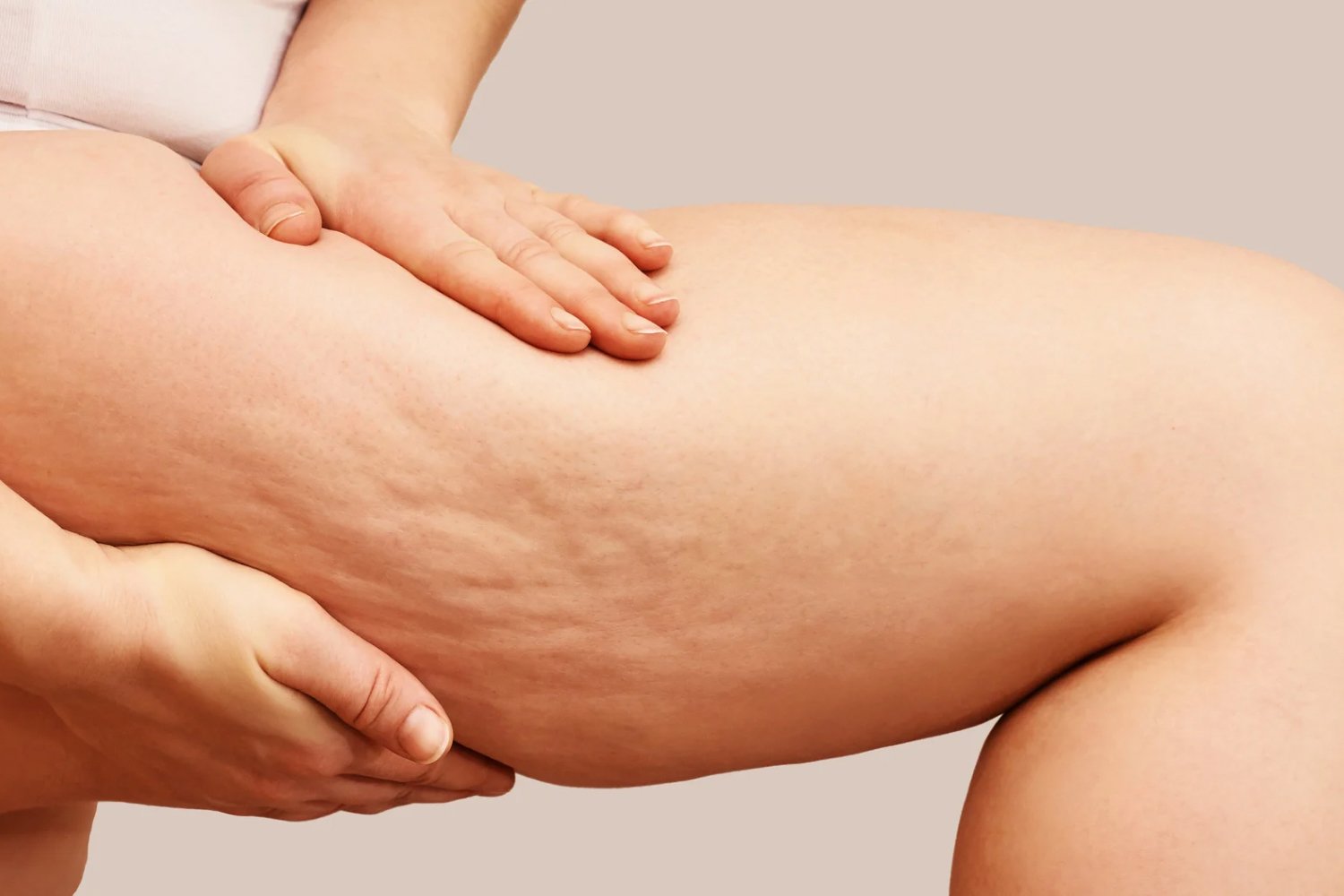 cellulite-reduction
