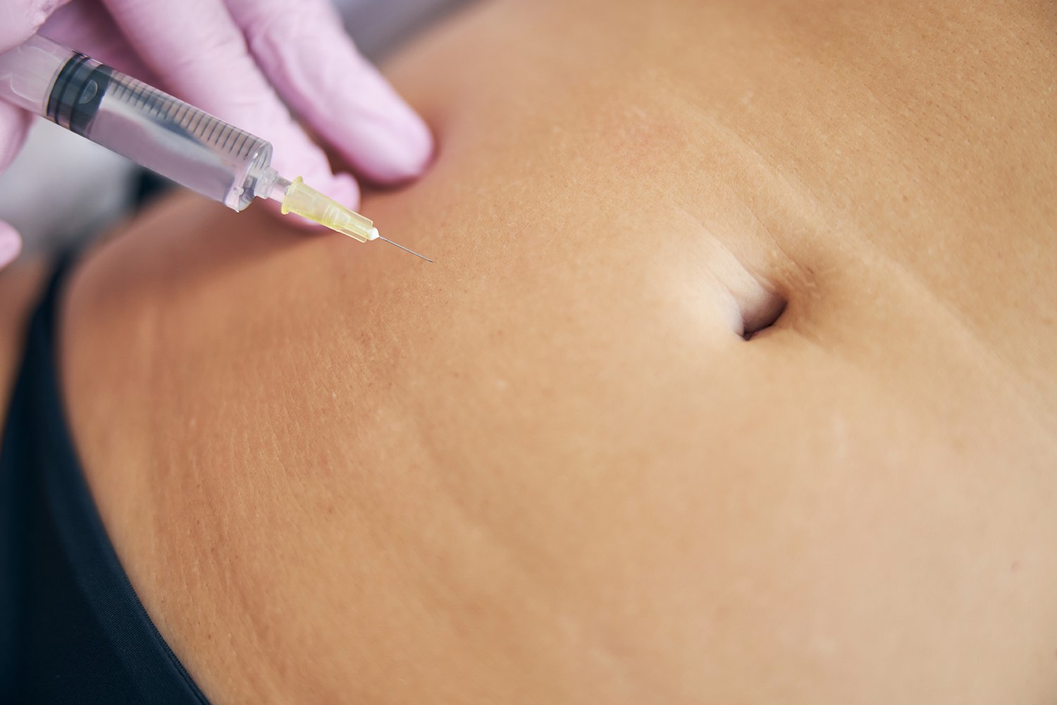 Stretch marks stem cells